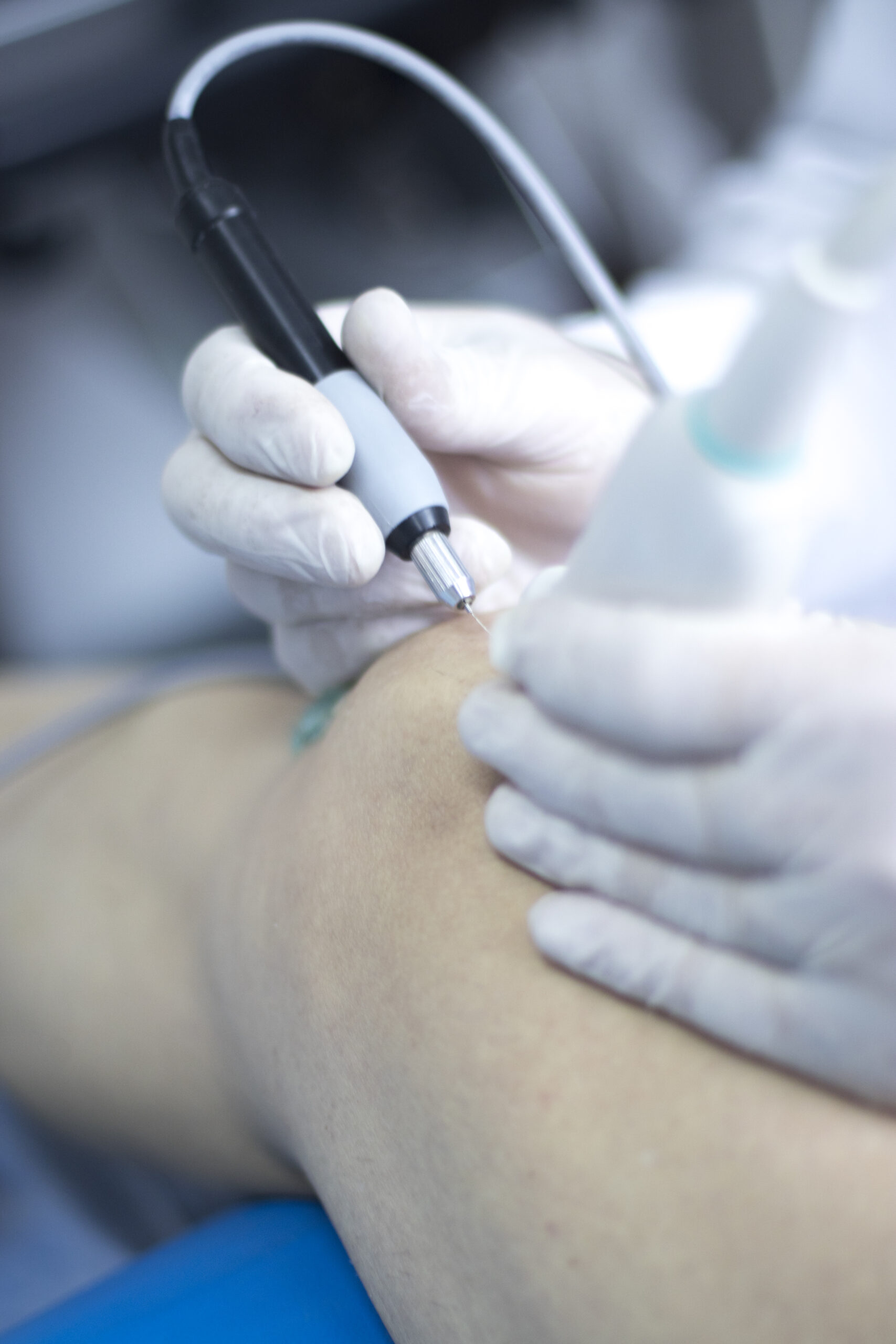 EPI Intratissue Percutaneous Electrolysis dry needling ultrasound physiotherapy medical treatment.